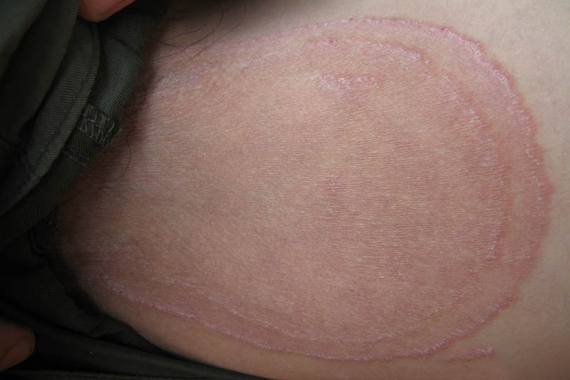 太原看体股癣医院，股癣的症状是什么